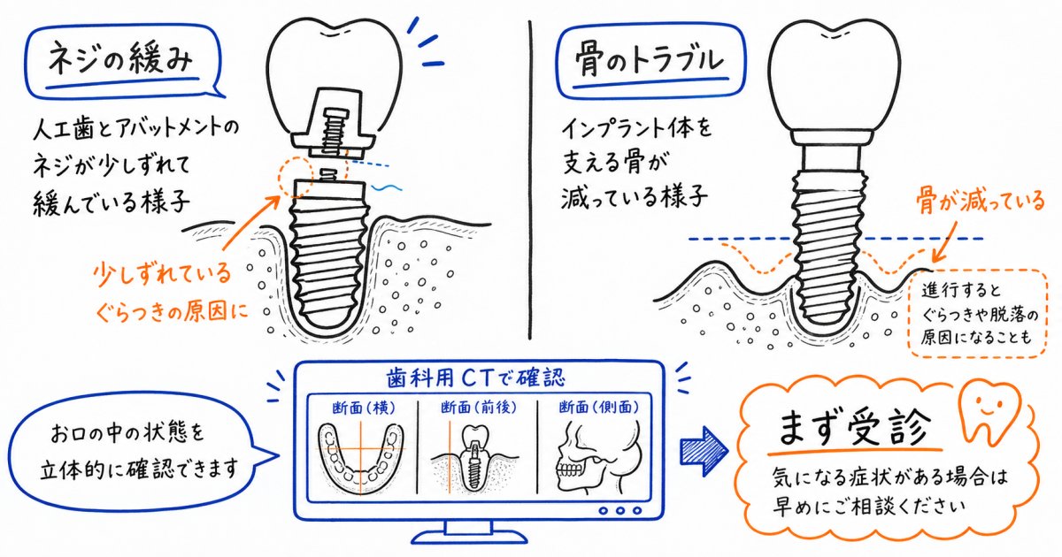 インプラントがグラグラ動く原因は?ネジ緩みか骨の病気か見分ける法