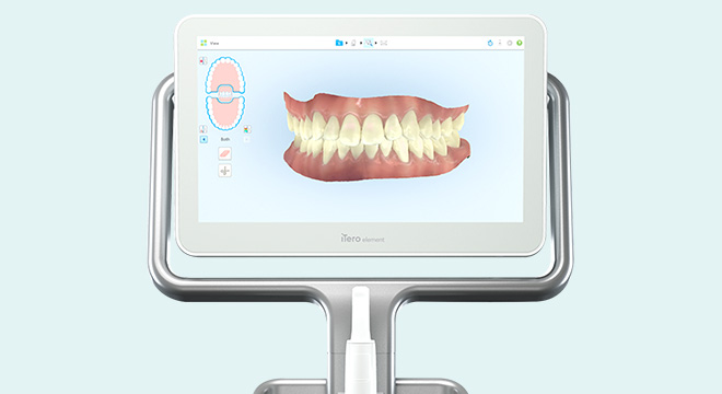 口腔内スキャナー(iTero)