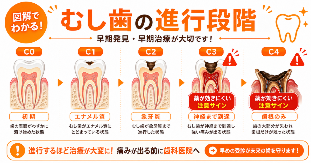 薬が効かないのはなぜ?むし歯放置による悪化の進行レベルと痛みの正体