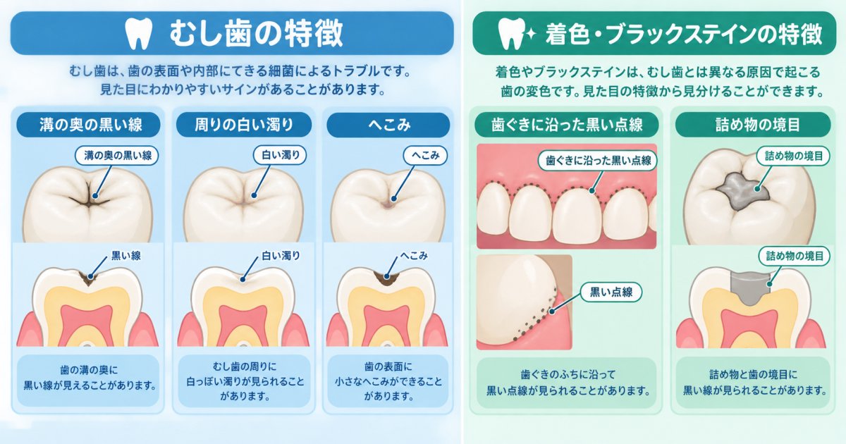 子どもの歯が黒いのはむし歯？着色？見た目だけで見分けにくいのはなぜ？